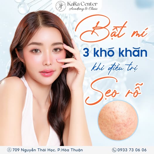 Điều trị sẹo rỗ Cao Lãnh với phác đồ cá nhân hóa theo từng loại sẹo